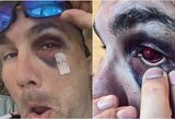 „Ar tai karma?“: varžovui į akis įdūręs Ch.Weidmanas po kovos pats atrodė lyg „Terminatorius“