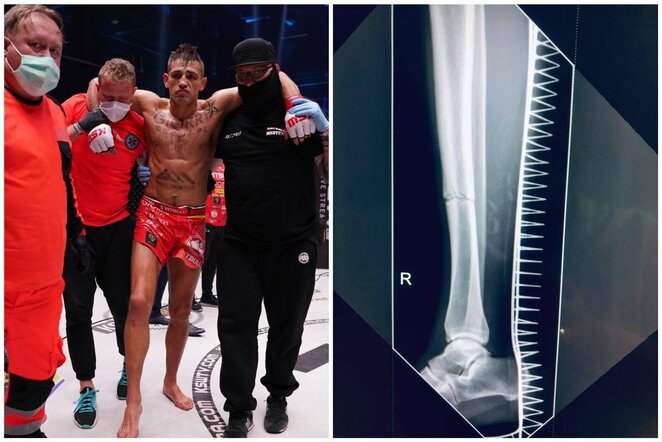 Andrzejus Grzebykas ir jo kojos rentgeno nuotrauka po kovos  | Organizatorių nuotr.